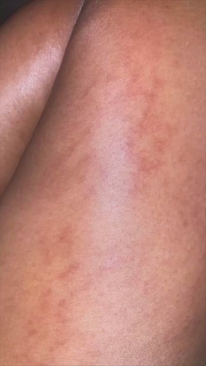 Peeling tca 20 % Zena